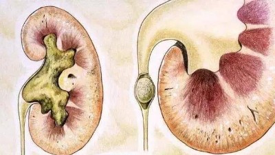 腎結(jié)石是怎么引起的？