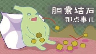 什么是膽囊結(jié)石？