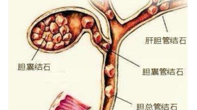 膽囊結(jié)石可以不切膽嗎？