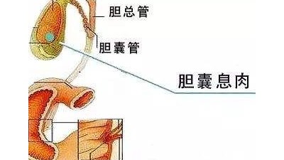 得了膽囊息肉怎么辦，如何治療？